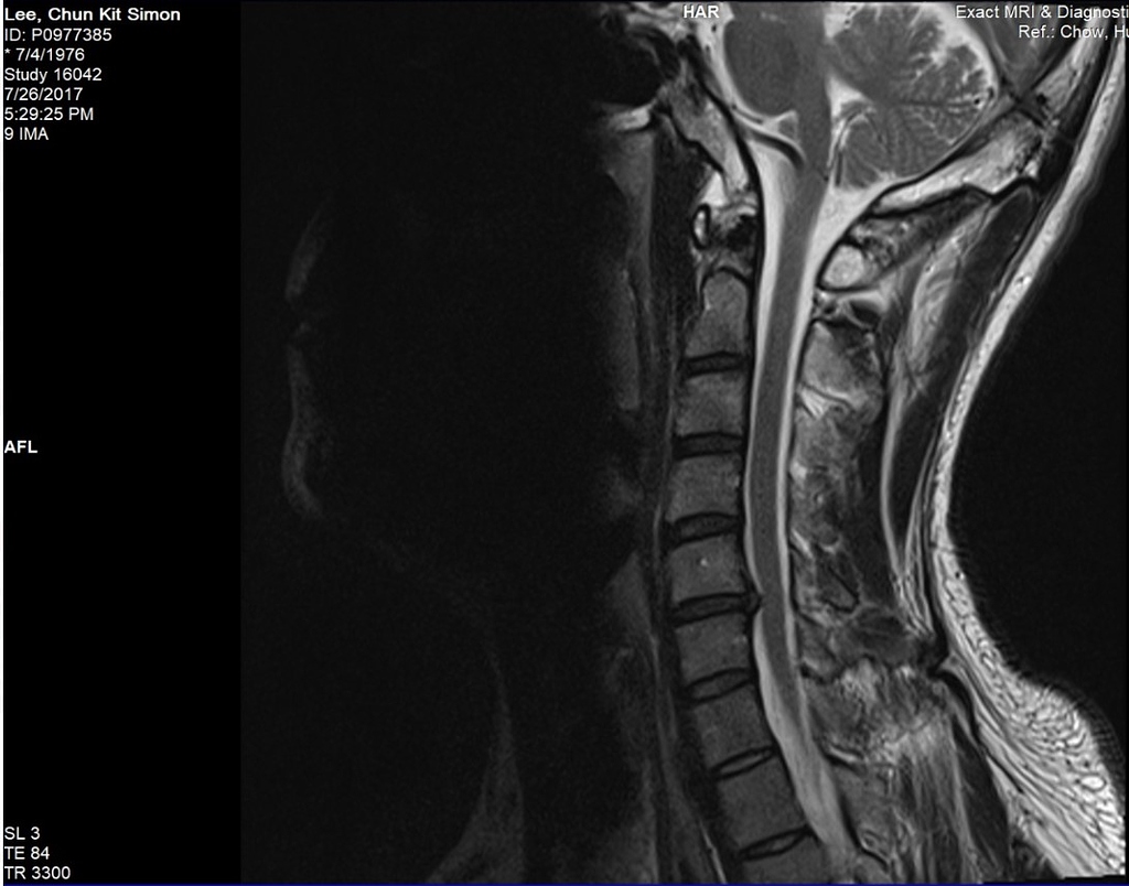 Cervical Herniated Disc C5 C6 Pain And Inflammation Flux Health Forum