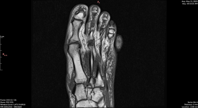 MRI